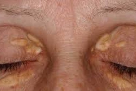 Điều trị dứt điểm u mỡ vàng